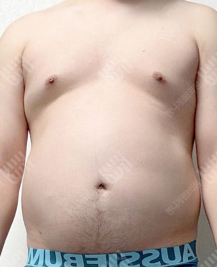 男性女乳症4 전
