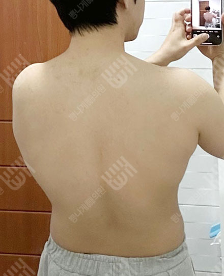 男性背部吸脂1 전