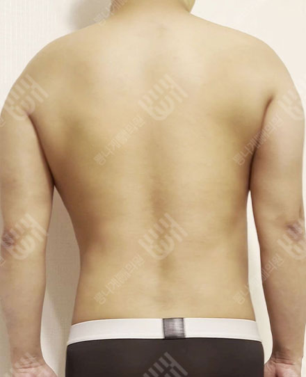 男性背部吸脂2 후