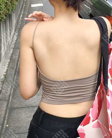 背部吸脂1 후