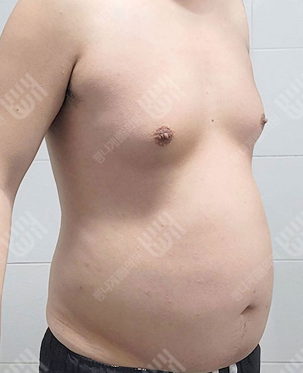 男性女乳症3 전