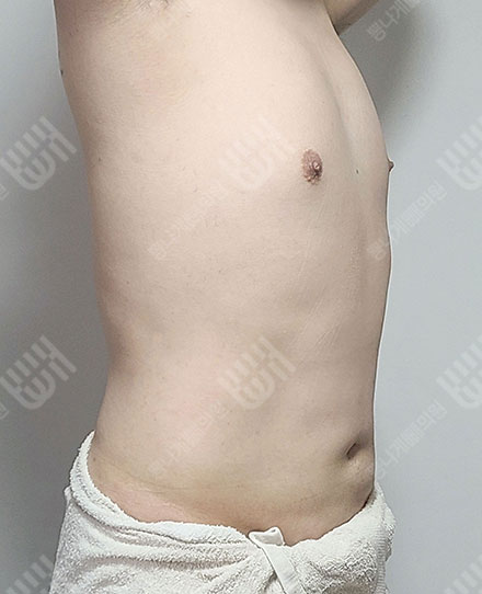 男性女乳症3 후