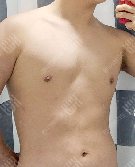 男性女乳症2 후