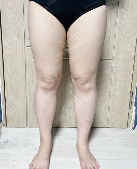 大腿吸脂4 전