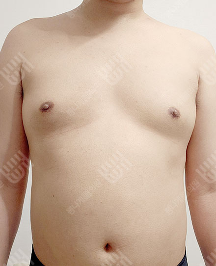 男性女乳症5 전