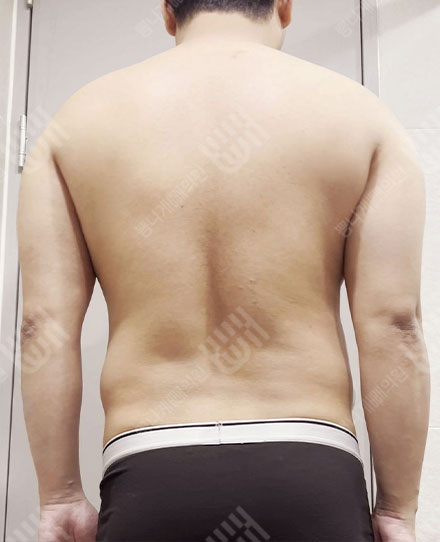 男性背部吸脂2 전