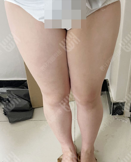 大腿吸脂 전