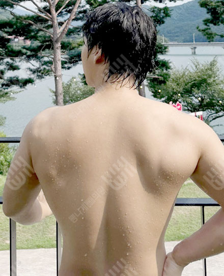 男性背部吸脂1 후