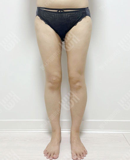 大腿吸脂4 후