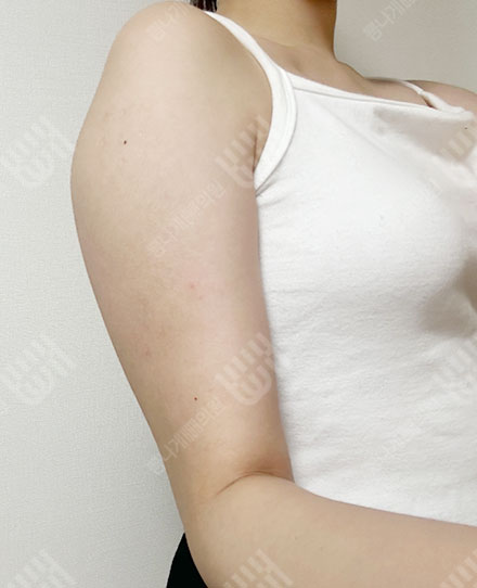 手臂吸脂 3 전