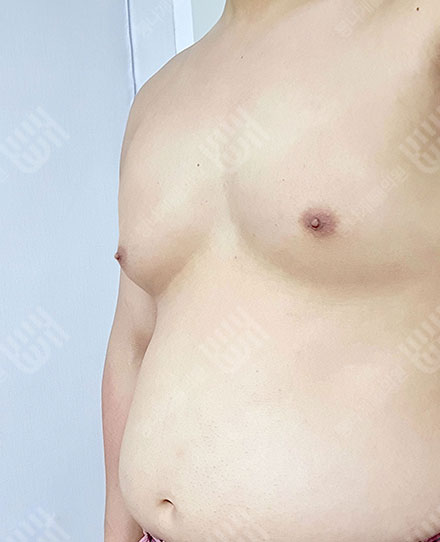男性女乳症2 전