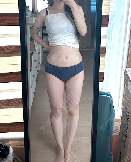 骨盘脂肪移植 3 후