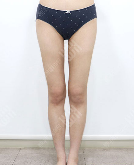 吸脂修复手术 3 후