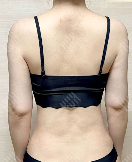 背部吸脂4 후