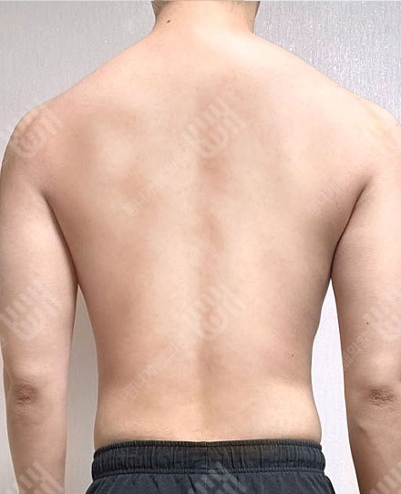 男性背部吸脂3 후