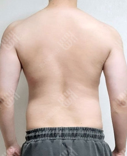 男性背部吸脂3 전