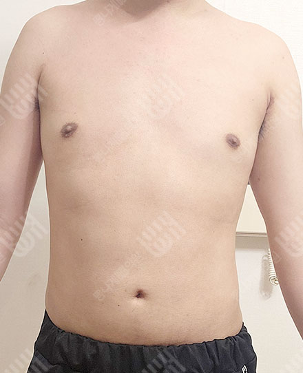 男性女乳症5 후