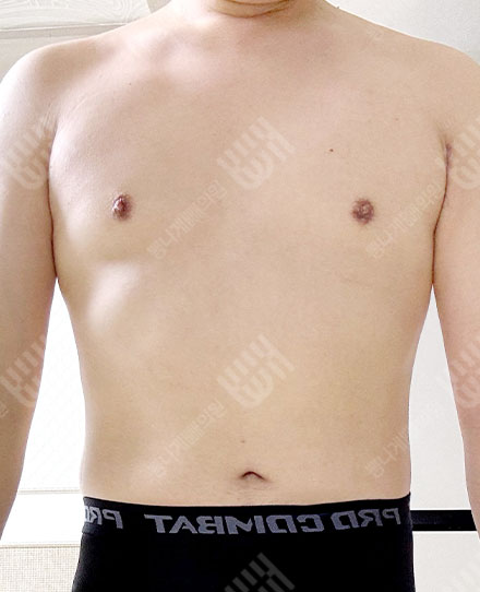 男性女乳症4 후