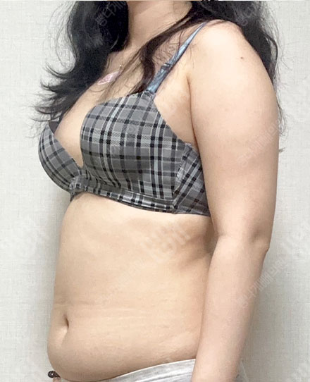手臂吸脂5 전