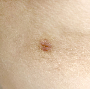 传统吸脂术后 2 个月