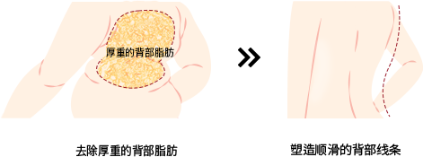 去除厚重的背部脂肪 ➤ 塑造顺滑的背部线条
