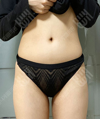 Before: 手术前