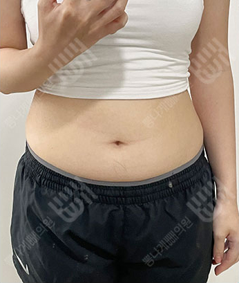 Before: 手术前