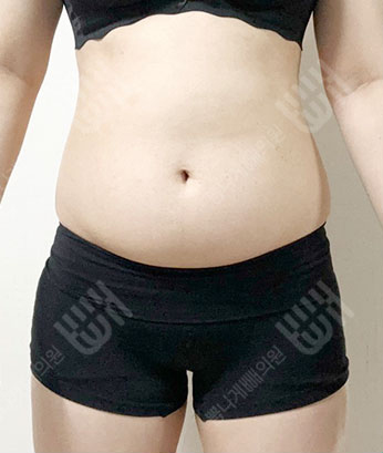 Before: 手术前