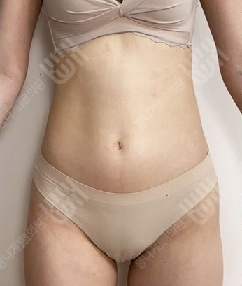 Before: 手术前