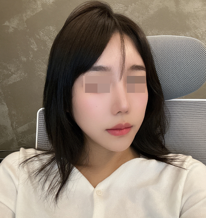 BBAE吸脂医院 面部脂肪移植
