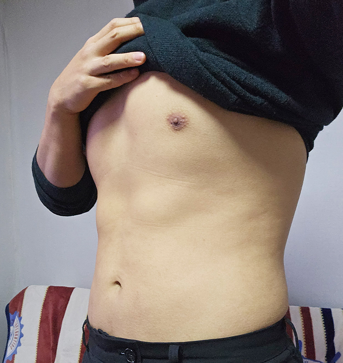 BBAE吸脂医院 男性女乳症