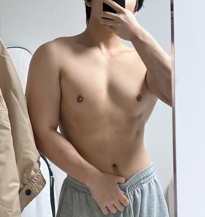 BBAE吸脂医院 腹部吸脂