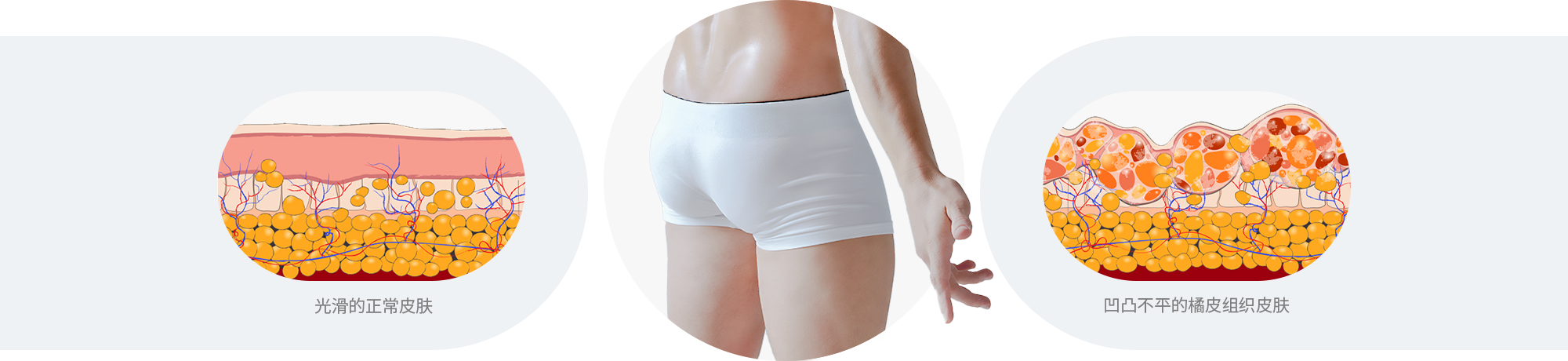 なめらかな通常の皮膚 or デコボコしたセルライト皮膚